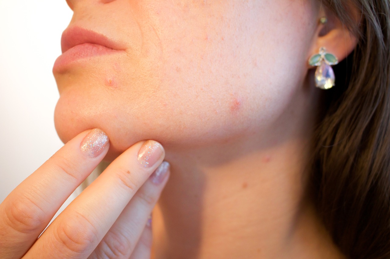 Reduce Your Acne With These Suggestions